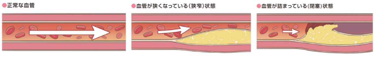 虚血性心疾患