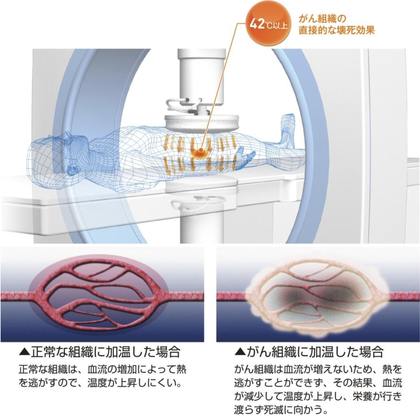 副作用の軽減を目指したがん治療