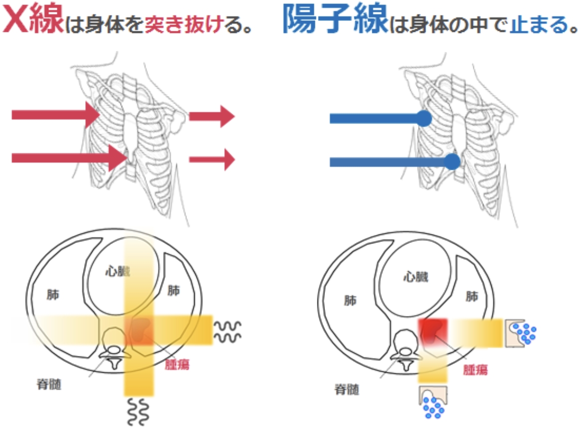 放射線・陽子線治療