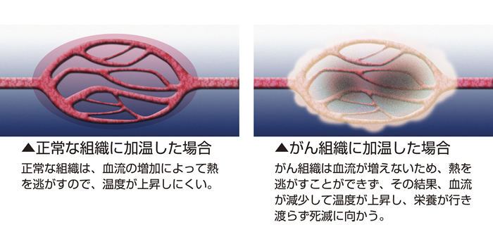 ハイパーサーミアの特長02