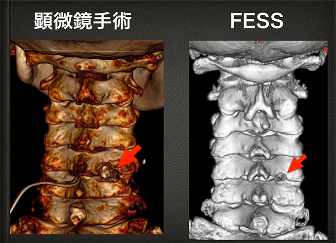 顕微鏡手術とFESSの術後