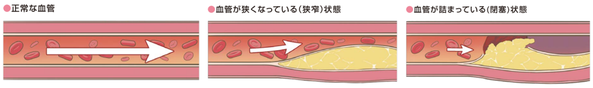 虚血性心疾患