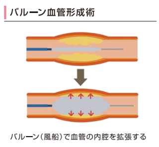 カテーテル治療